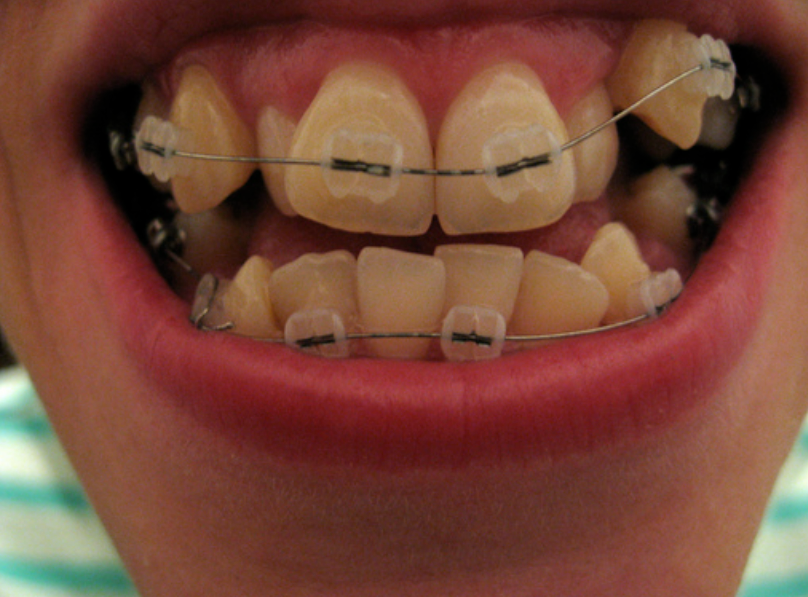 Before Treatment